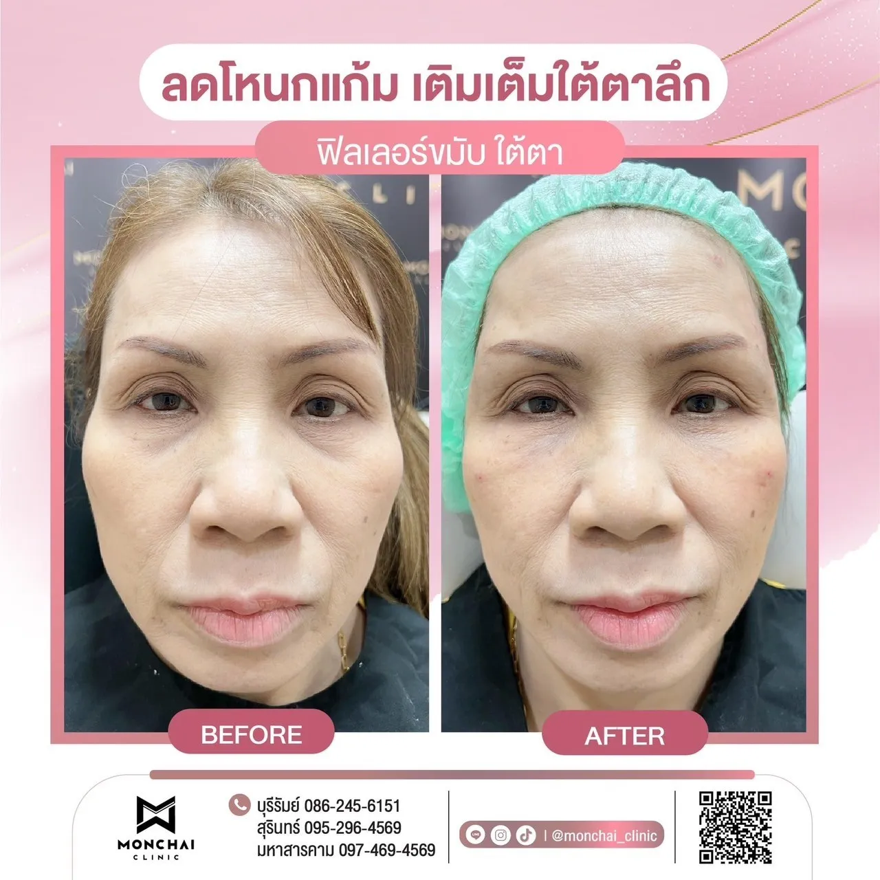 LINE_ALBUM_รีวิว ฟิลเลอร์_250102_9_result
